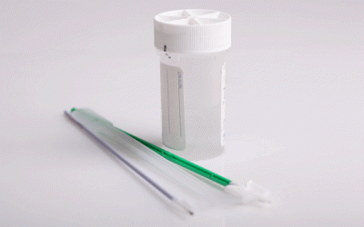 Première mondiale: un test salivaire détecte un cancer oropharyngé occulte lié au HPV