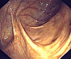 Cancer colorectal : Étude randomisée du dépistage par coloscopie