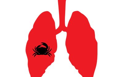 Dépistage du cancer du poumon